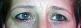 Swelling from Permanent Make-up