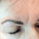 Correcting asymmetrical brows